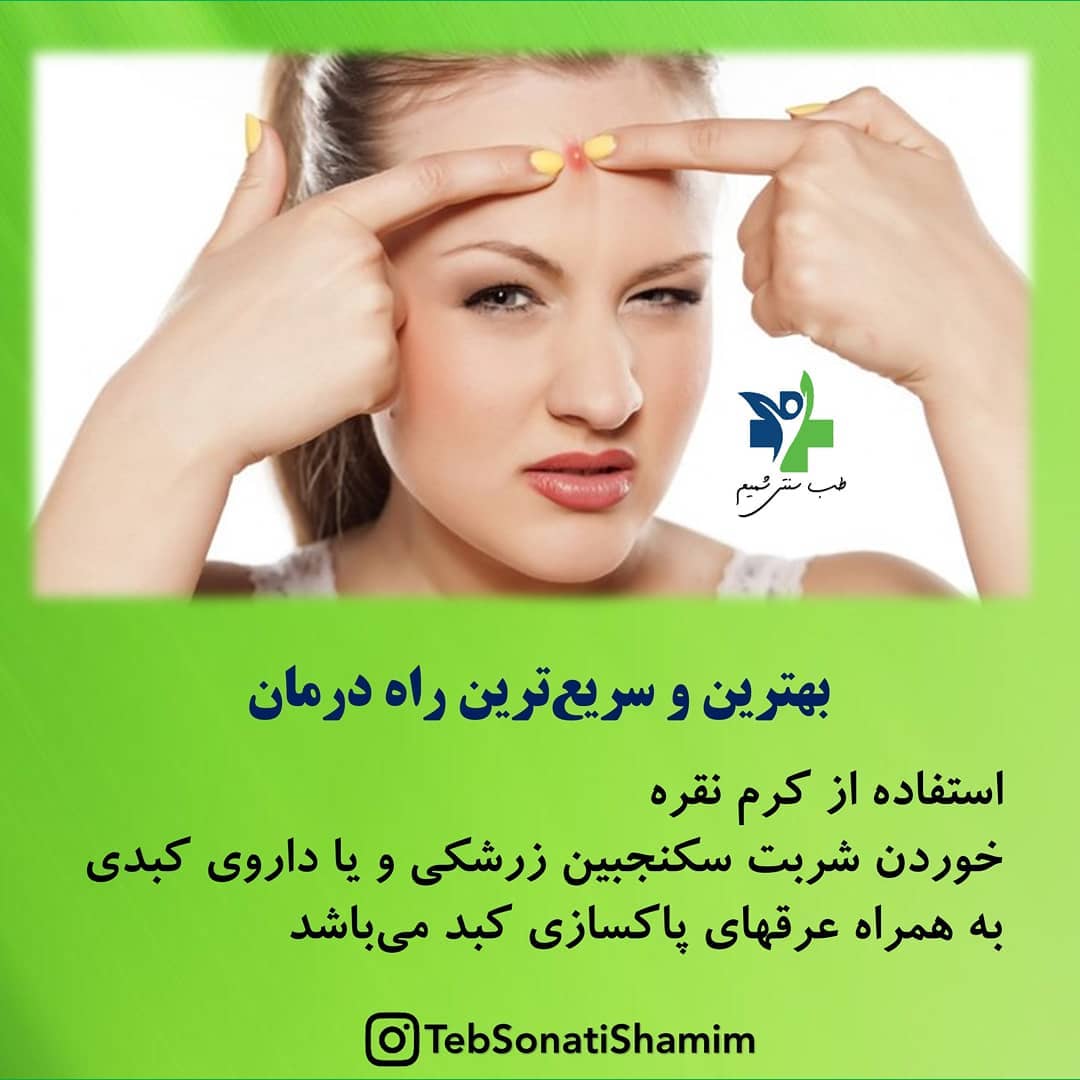 درمان جوش‌ سرسفید