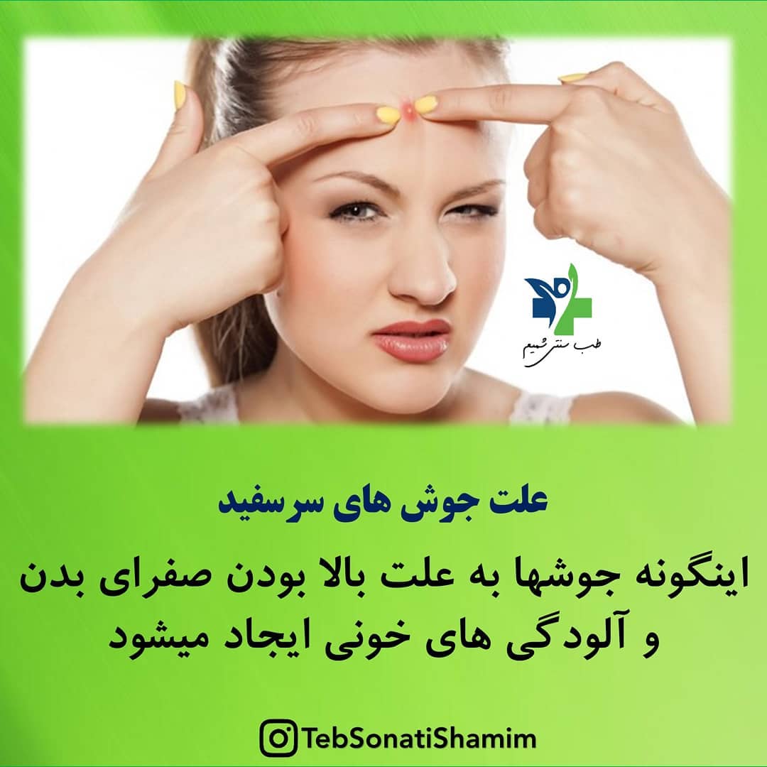 علت جوش های سر سفید